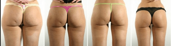 ”Lipodissolve