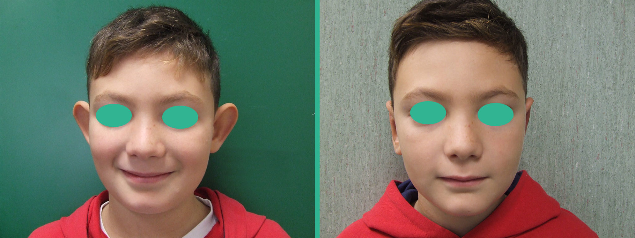 Prima e dopo intervento di chirurgia plastica